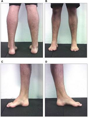 An 8-month adapted motor activity program in a young CMT1A male patient